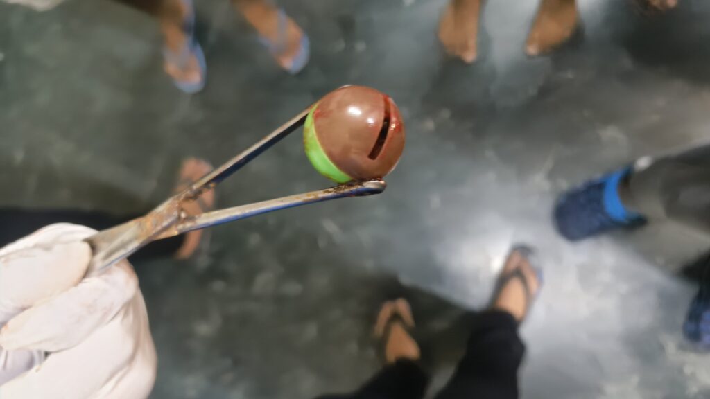 सरस्वती इंस्टिट्यूट ऑफ मेडिकल साईसेंस के डॉक्टरों नें बच्चे के गले मे फंसी बॉल को सफलतापूर्वक निकाला
